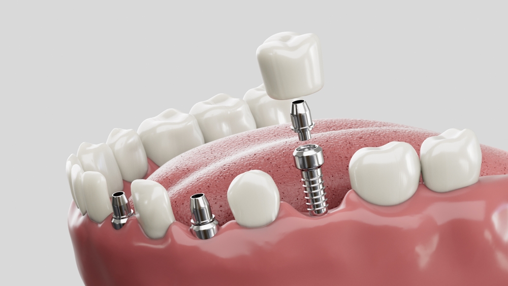 How Do Dental Implants Work? Benefits, Procedure & Recovery