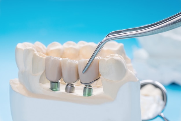dental bridges in hamilton